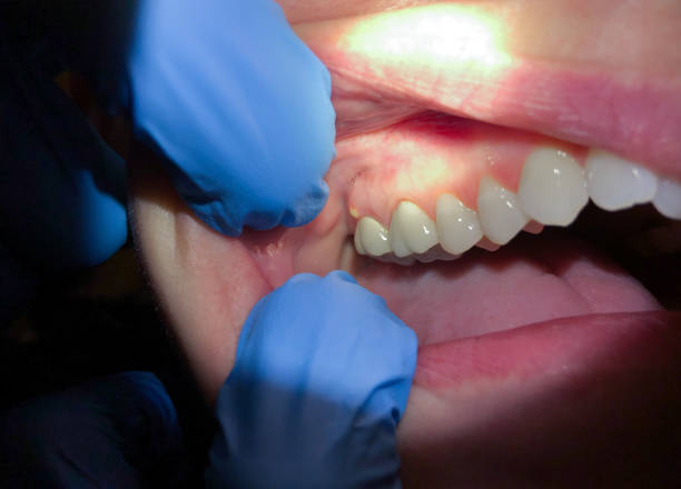 Best Tooth Infection Emergency Dentist  in Weatherford, OK